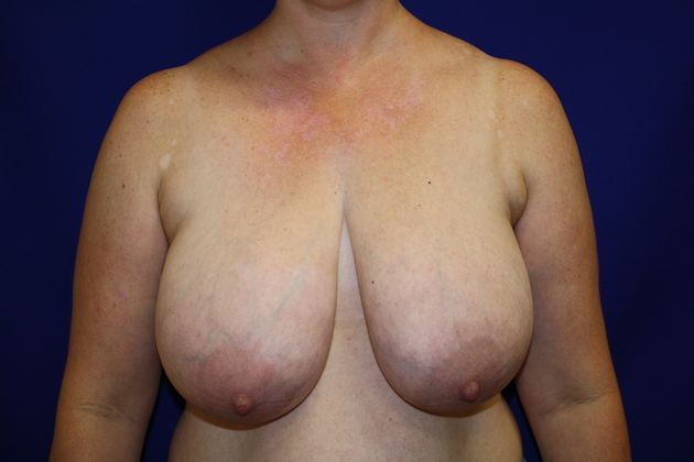 Breast Reduction Case 4 - Before