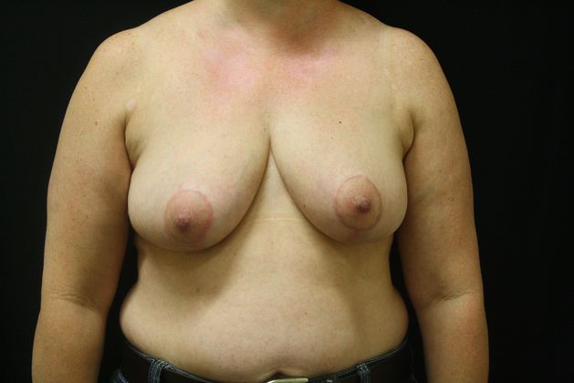 Breast Reduction Case 4 - After