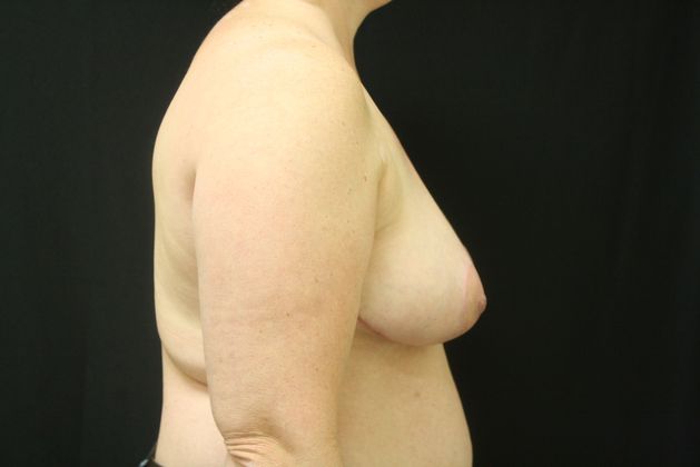 Breast Reduction: Case 4 - After