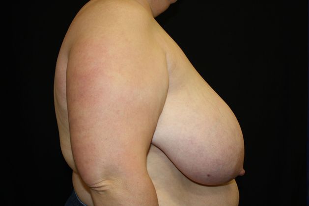 Breast Reduction: Case 5 - Before
