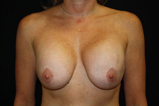 Breast Augmentation Exchange/Revision Case 2 - Before