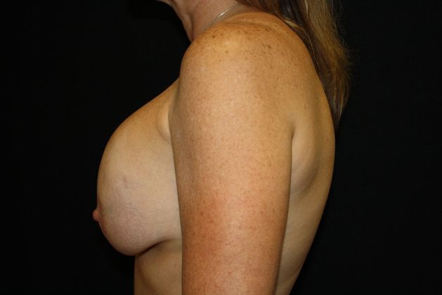 Breast Augmentation Exchange/Revision: Case 2