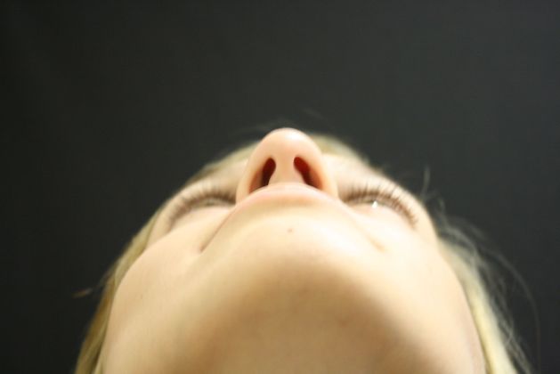 Rhinoplasty: Case 1 - Before