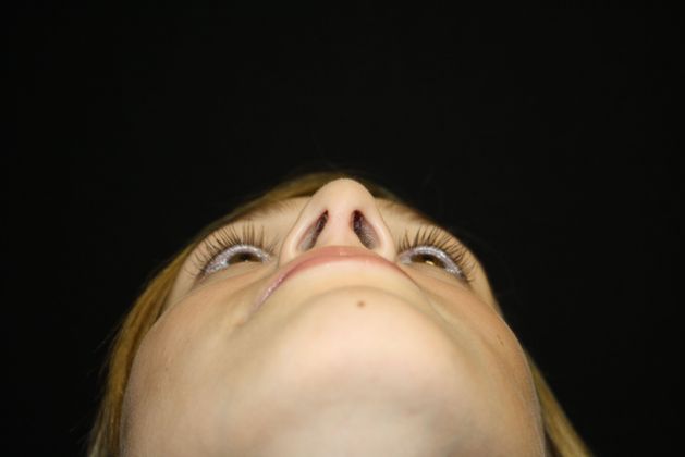 Rhinoplasty: Case 1 - After