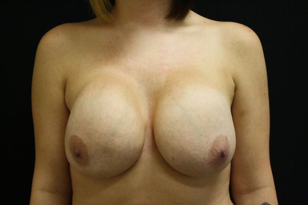 Breast Augmentation Exchange/Revision Case 3 - Before