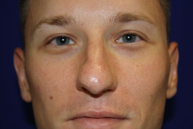 Rhinoplasty: Case 3 - Before
