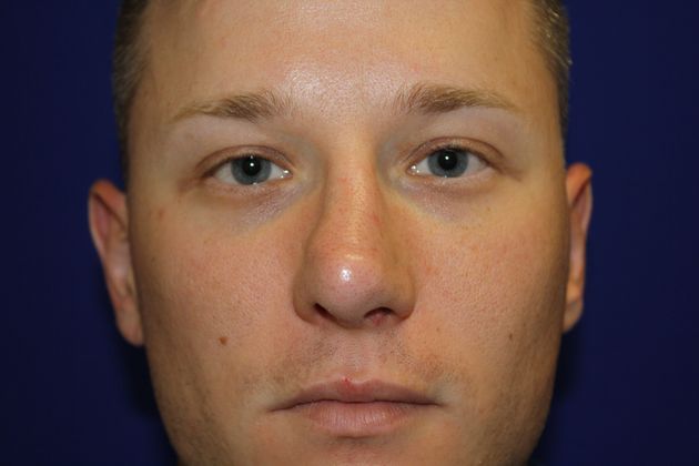 Rhinoplasty: Case 3 - After