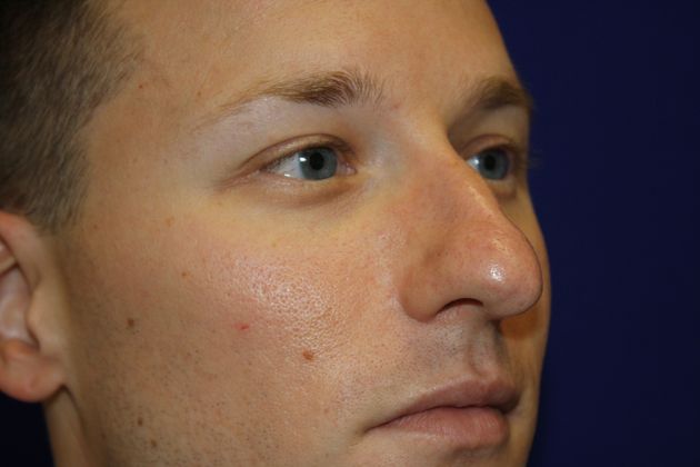 Rhinoplasty: Case 3 - Before