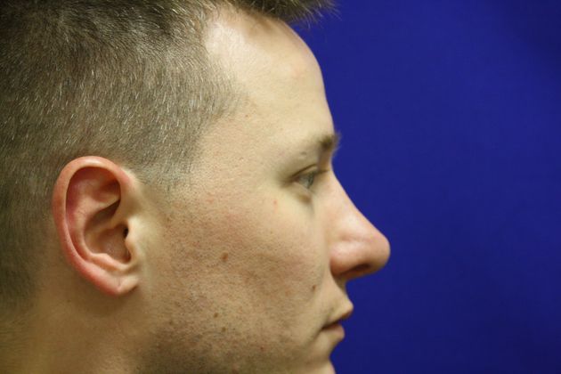 Rhinoplasty: Case 3 - After