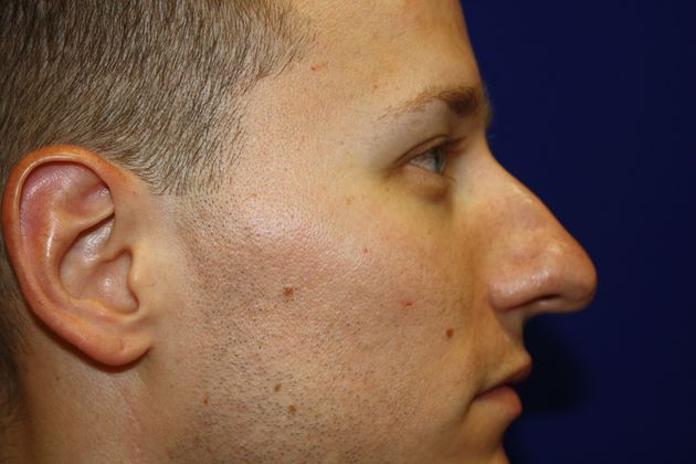 Rhinoplasty: Case 3 - Before