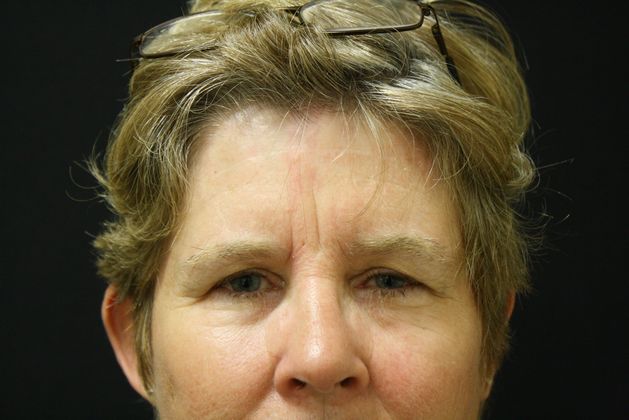 Eyelid Surgery Case 2 - Before