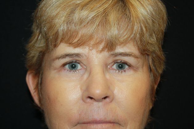 Eyelid Surgery Case 2 - After