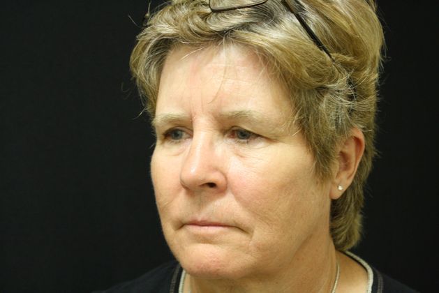 Eyelid Surgery: Case 2 - Before