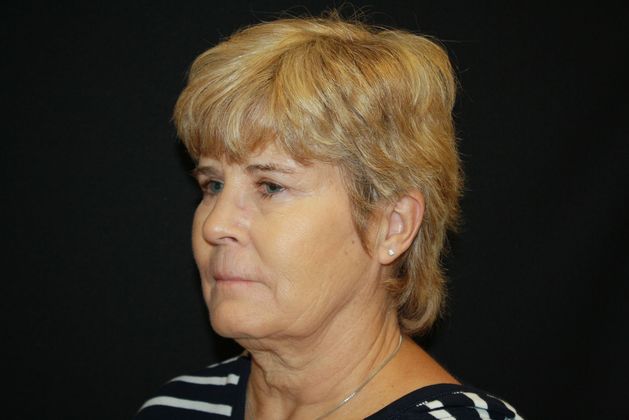 Eyelid Surgery: Case 2 - After