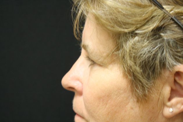 Eyelid Surgery: Case 2 - Before