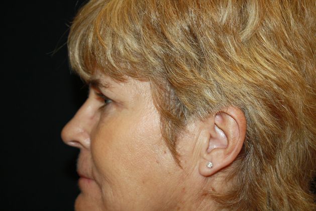 Eyelid Surgery: Case 2 - After