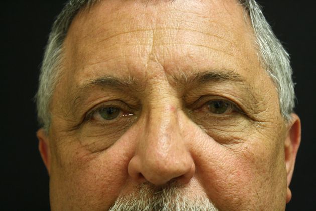 Eyelid Surgery Case 3 - Before