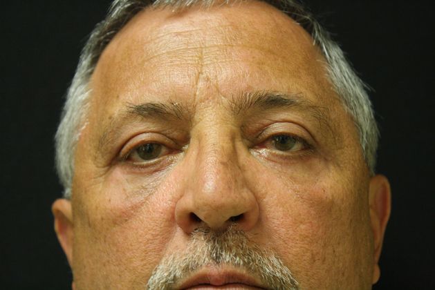 Eyelid Surgery Case 3 - After