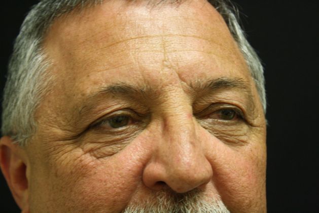 Eyelid Surgery: Case 3 - Before