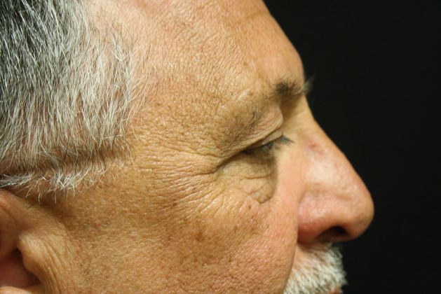 Eyelid Surgery: Case 3 - Before