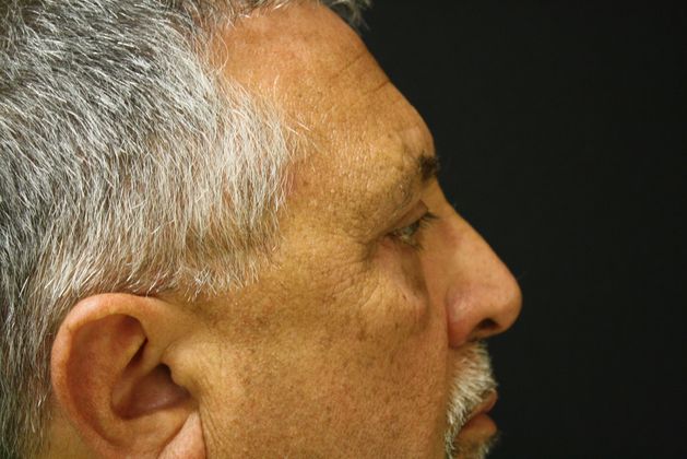 Eyelid Surgery: Case 3 - After