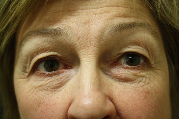 Eyelid Surgery Case 4 - Before