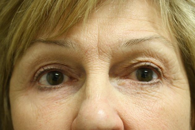 Eyelid Surgery Case 4 - After