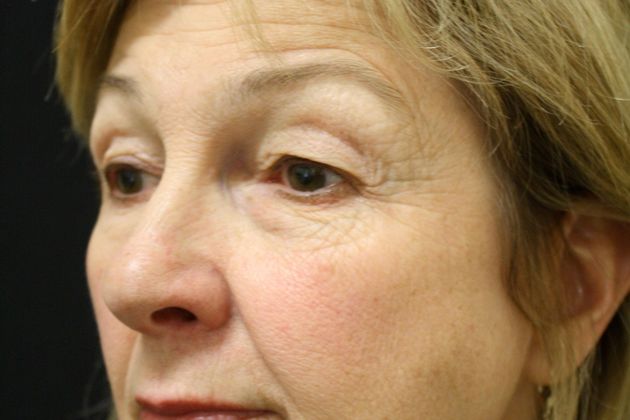 Eyelid Surgery: Case 4