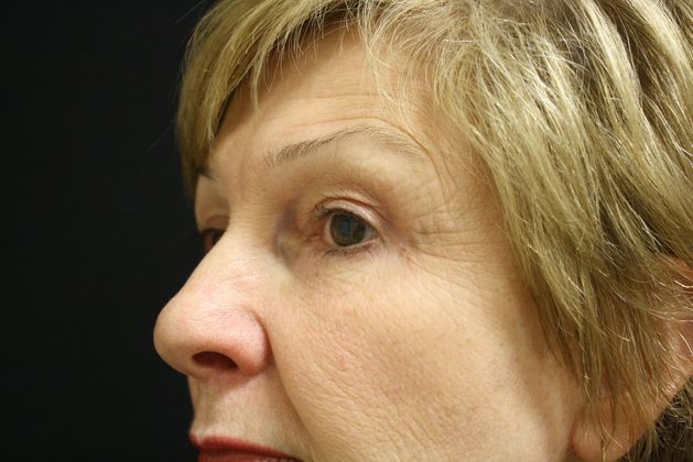 Eyelid Surgery: Case 4