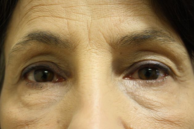 Eyelid Surgery Case 5 - Before