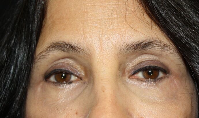 Eyelid Surgery Case 5 - After
