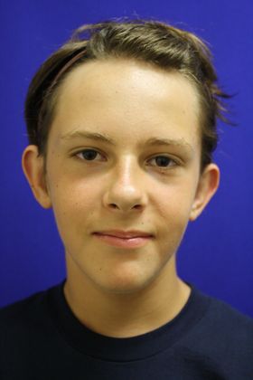 Ear Surgery - Otoplasty Case 2 - Before