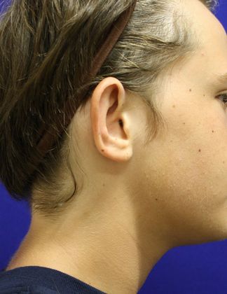 Ear Surgery - Otoplasty: Case 2