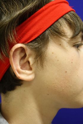 Ear Surgery - Otoplasty: Case 2