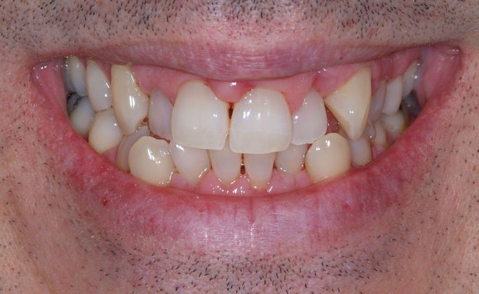 Orthodontics: Case 2 - Before