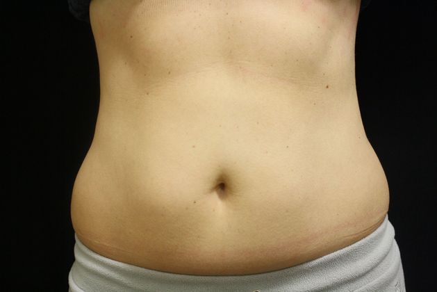 CoolSculpting Case 1 - After