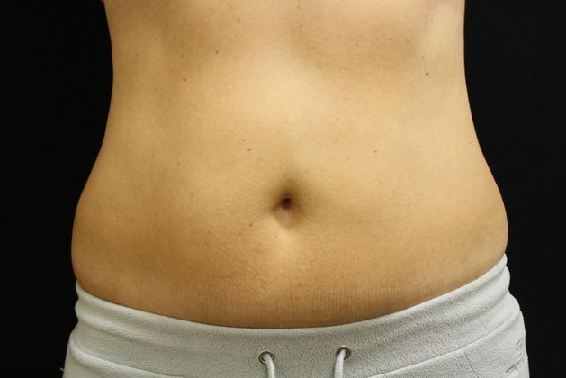 CoolSculpting: Case 1 - After 2 treatments