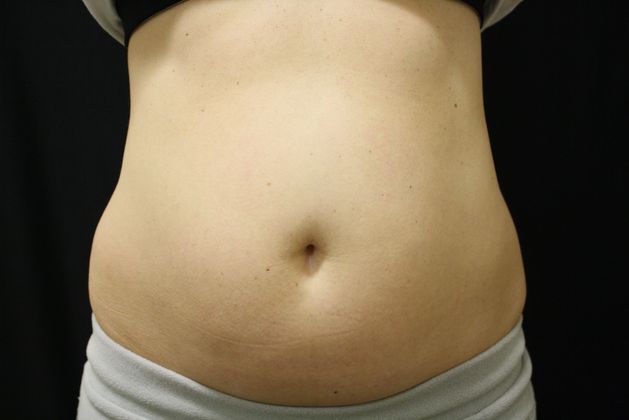 CoolSculpting: Case 1 - Before