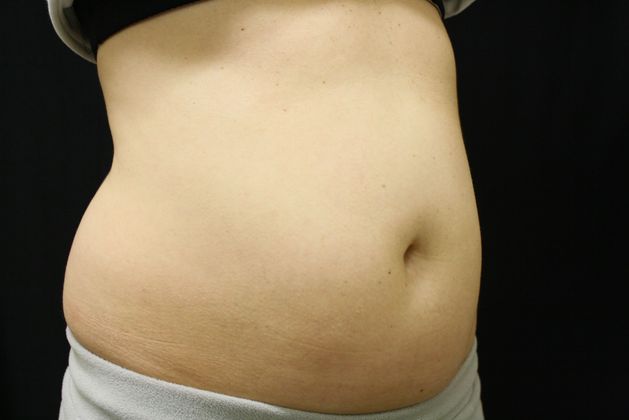 CoolSculpting: Case 1 - Before