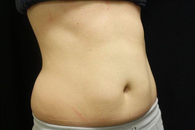 CoolSculpting: Case 1 - After