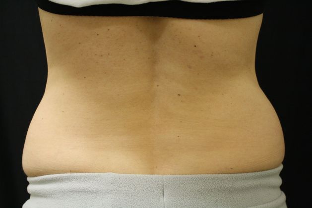 CoolSculpting: Case 1 - Before