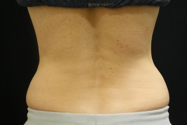 CoolSculpting: Case 1 - After