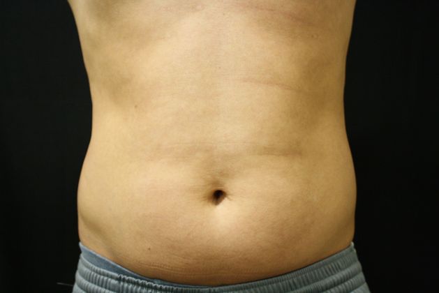 CoolSculpting Case 2 - Before