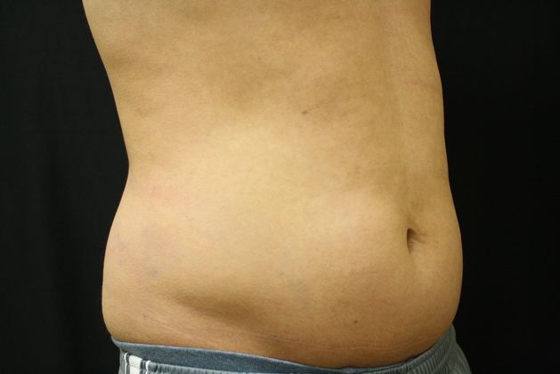 CoolSculpting: Case 2 - Before
