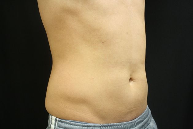 CoolSculpting: Case 2 - After
