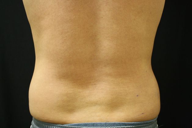 CoolSculpting: Case 2 - Before