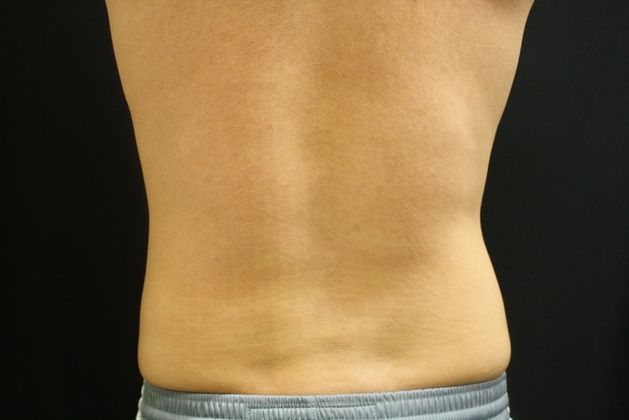 CoolSculpting: Case 2 - After