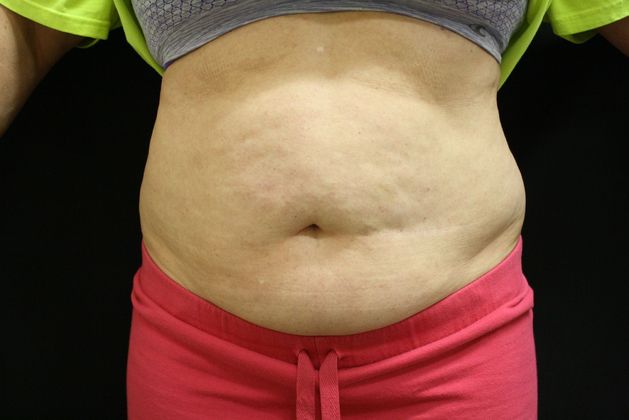 CoolSculpting Case 3 - Before