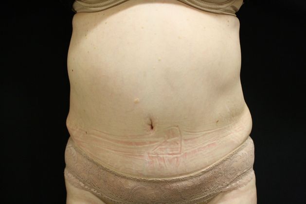 CoolSculpting Case 4 - Before