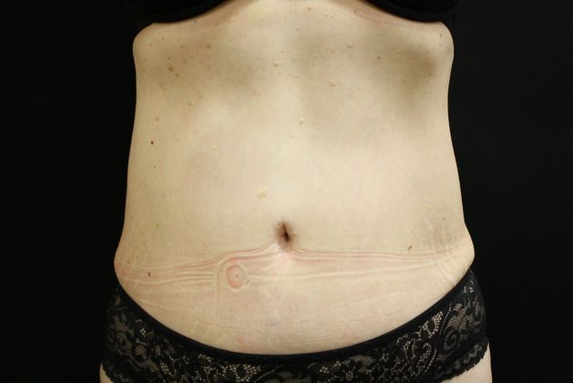 CoolSculpting Case 4 - After